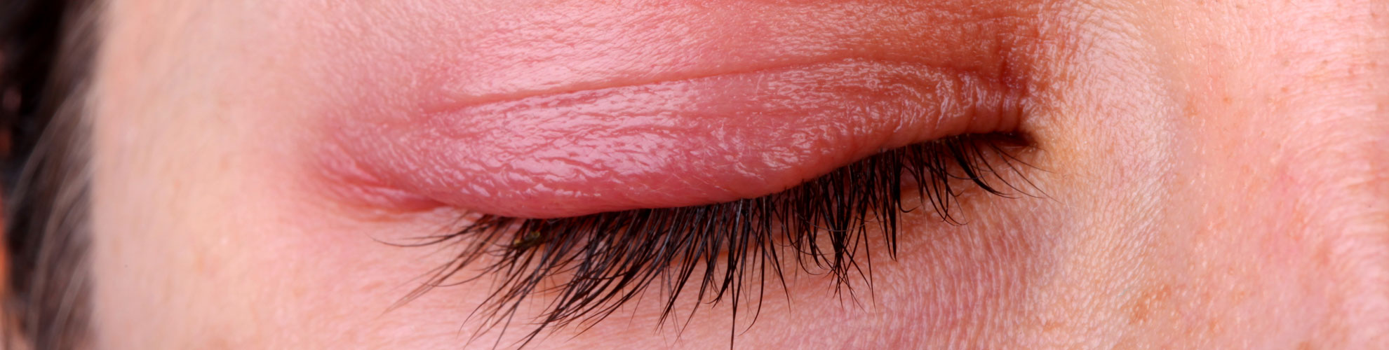 Blepharitis Treatment