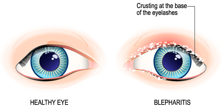 Anterior Blepharitis diagram