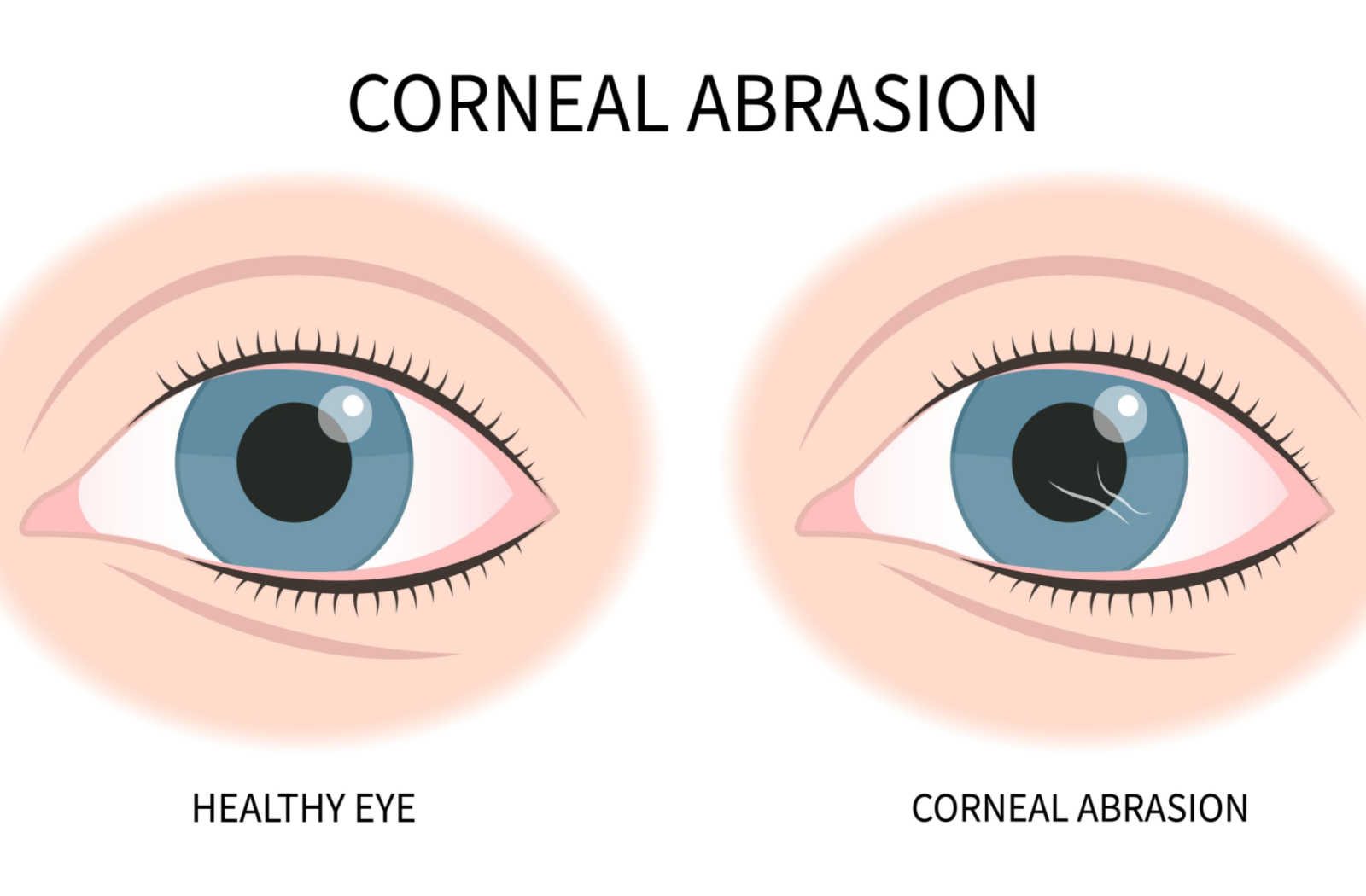 Normal eye and eye with corneal abrasion