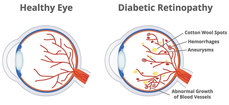 Healthy eye compared to one with diabetic rentiopathy
