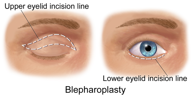 Comparison of eyes before and after eyelid surgery