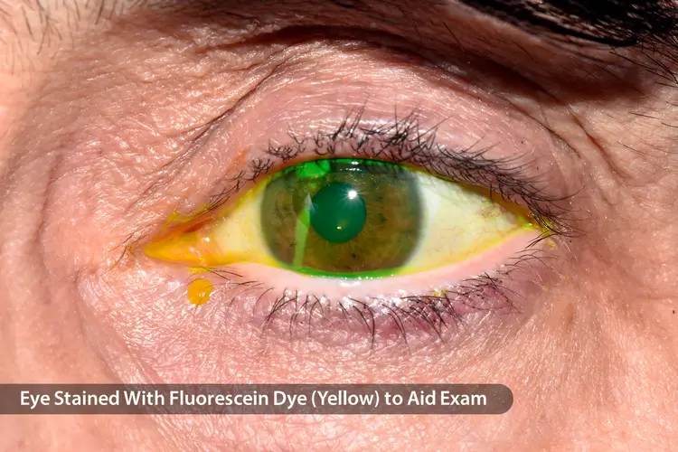 Eye stained with dye(Fluorescein)