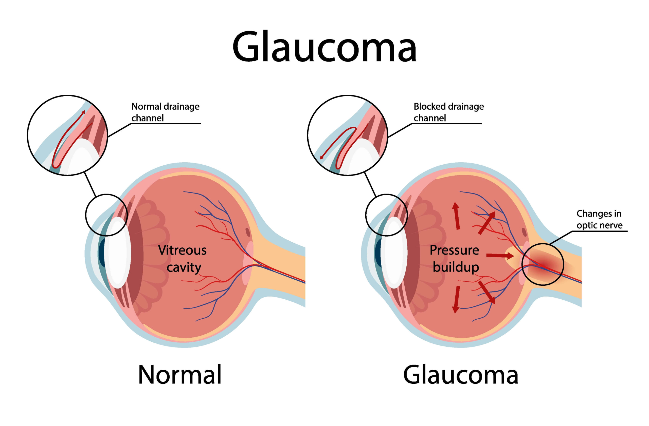 Healthy eye compared to eye with glaucoma