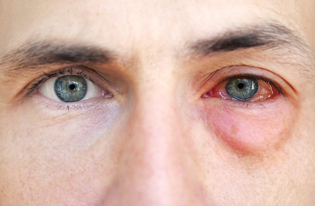 Inflamed eye in allergy season