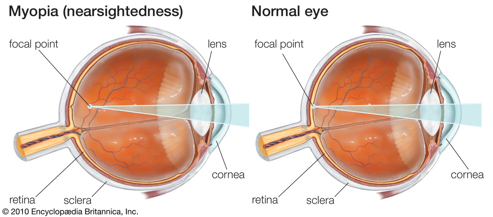 Myopia compared to healthy eye