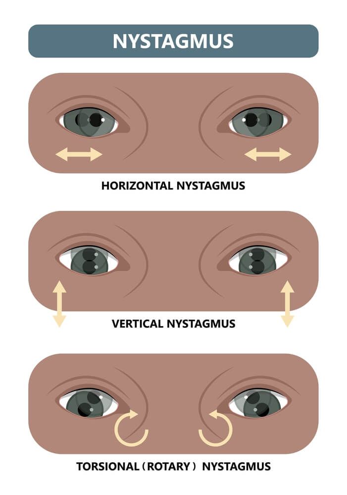 Nystagmus Eye Chart