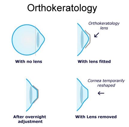 diagram of how rigid contact lenses work