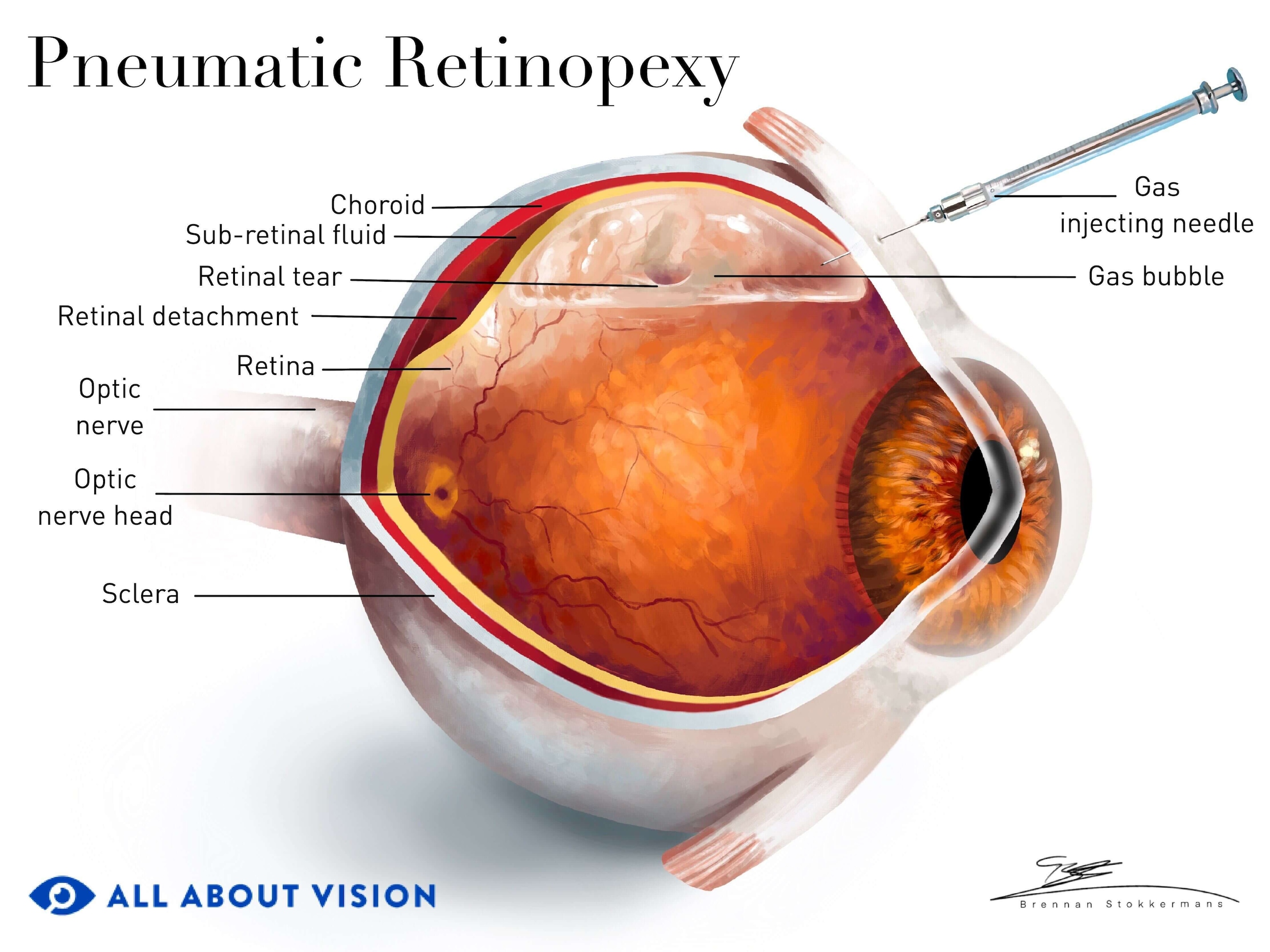 Pneumatic retinopexy diagram