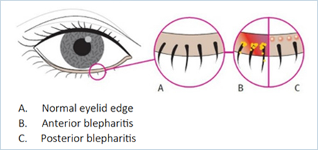 Posterior Blepharitis diagram
