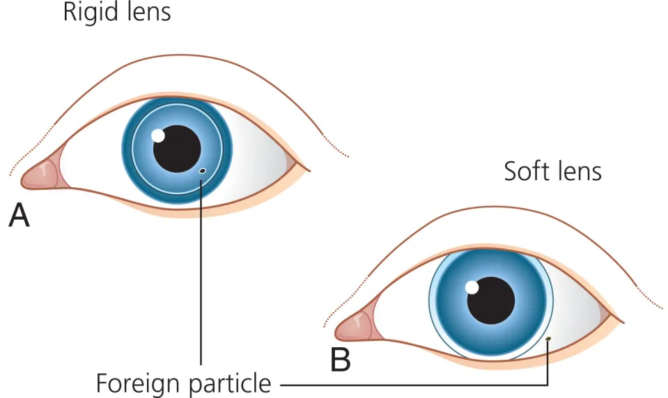 Rigid lens and soft lens diagram