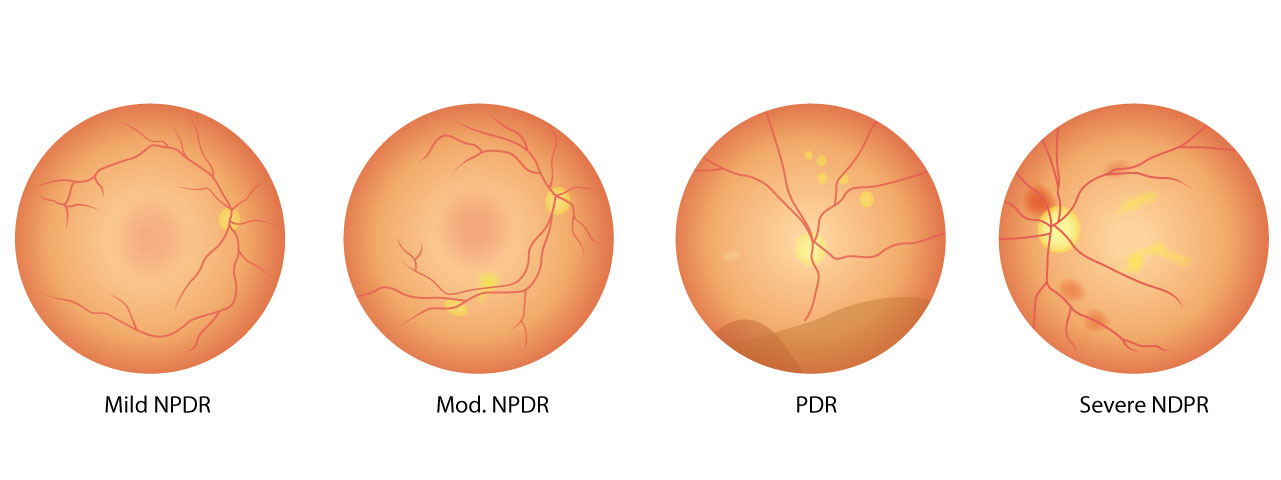 Stages of diabetic eye disease