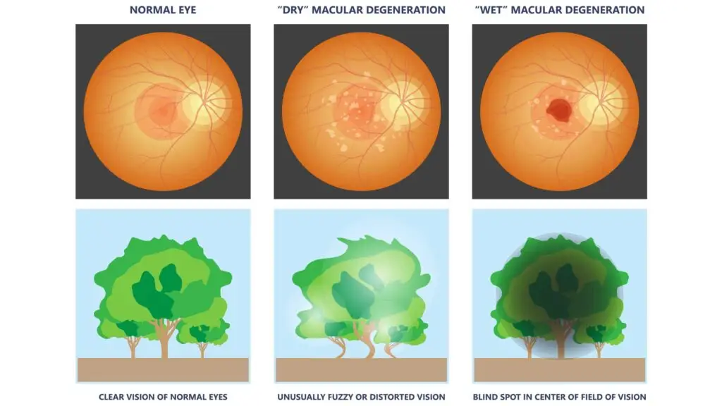 Types of macular degeneration