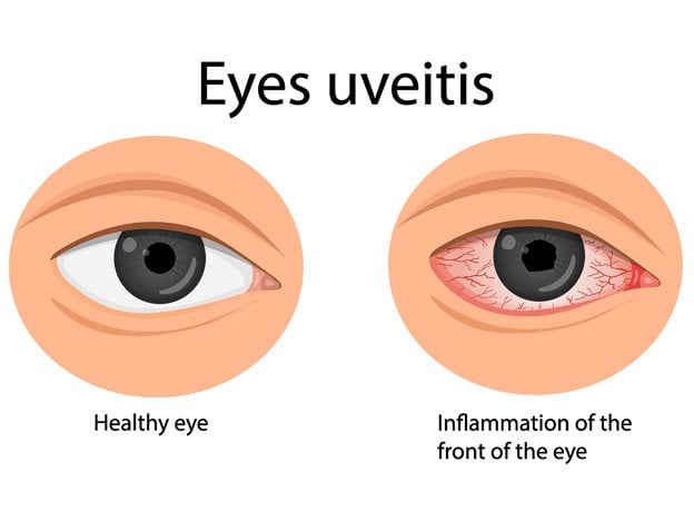 Healthy eye compared to Uveitis