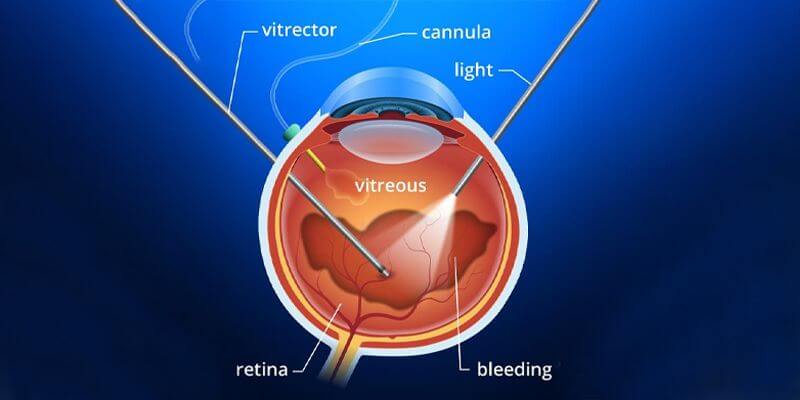 Vitrectomy diagram